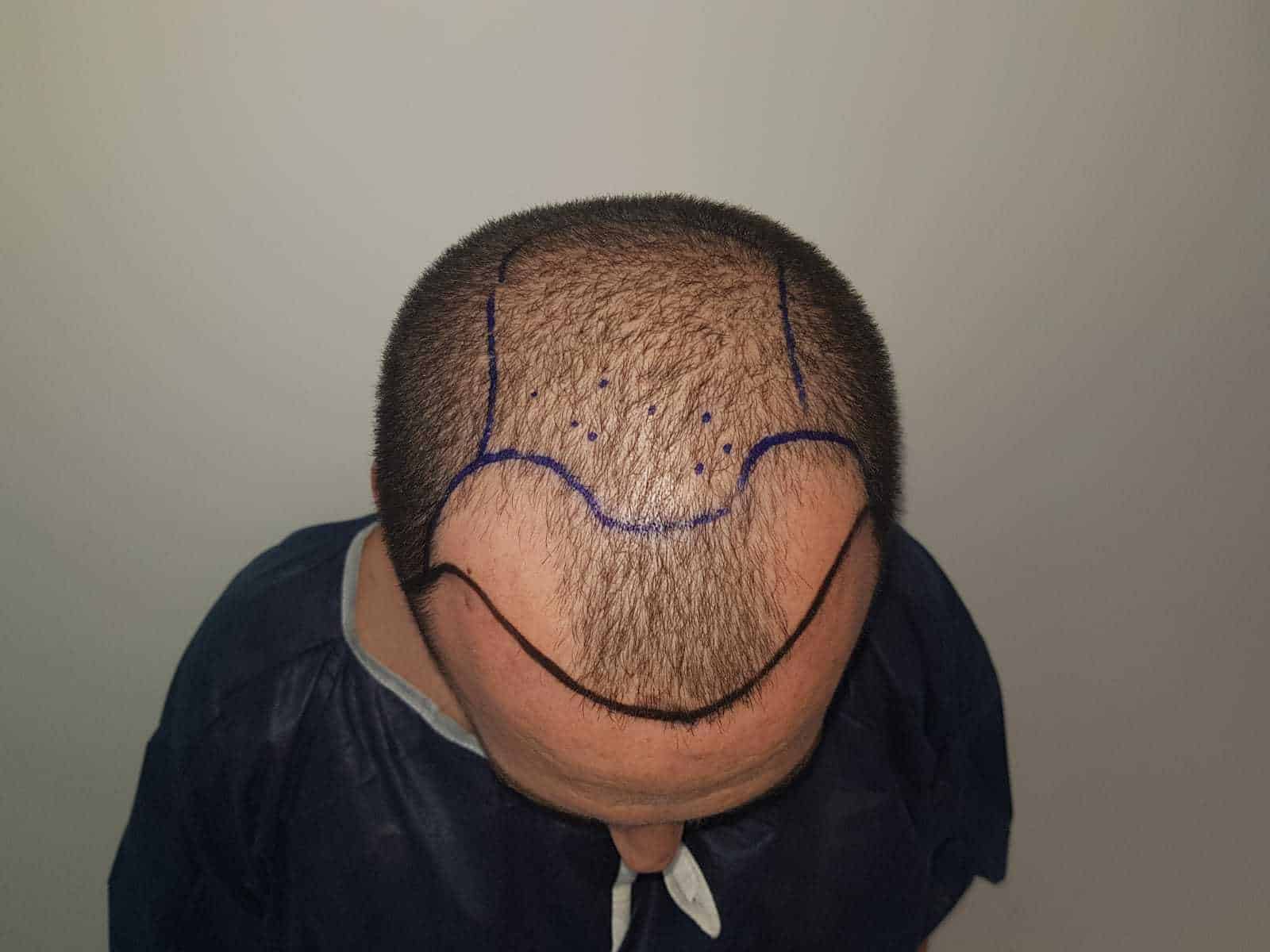 5 סוגים שונים של קווי שיער אפשריים