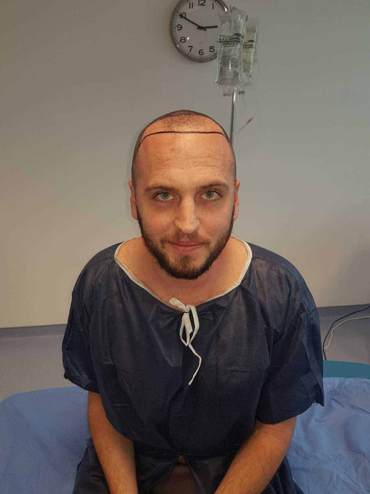 כמה השתלות שיער צריך לעשות