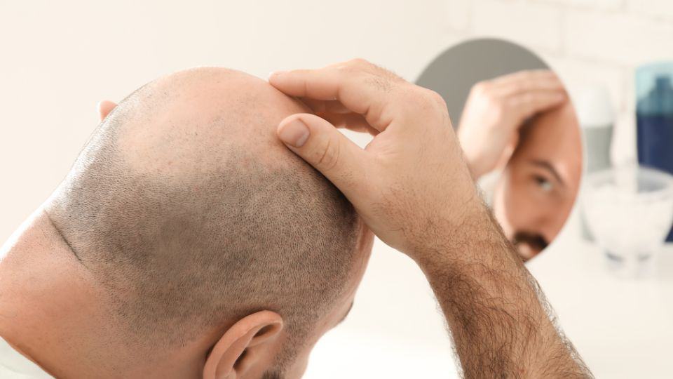 בארץ או בחו"ל? כך תבחרו השתלת שיער בצורה נכונה