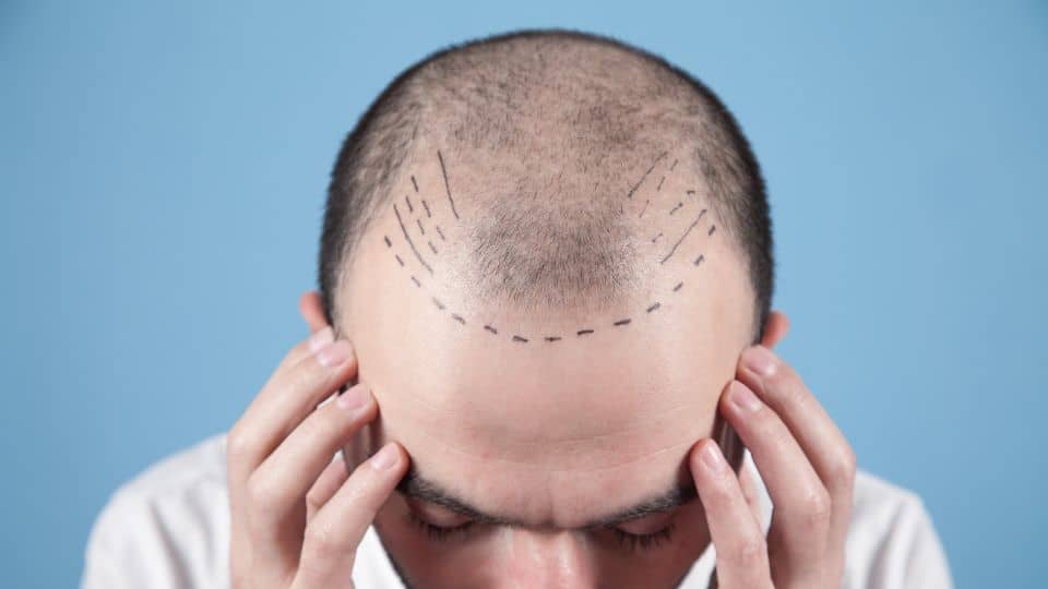 מה ההבדל בין השתלת שיער לשיקום שיער?